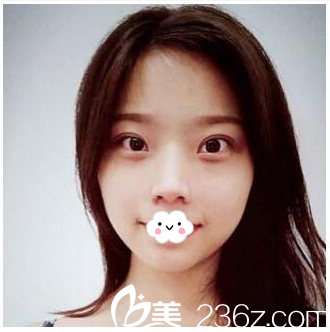 做完双眼皮23天的我 做完双眼皮23天的我