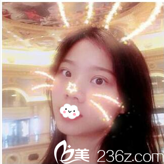 珠海科美张民望双眼皮15天效果 珠海科美张民望双眼皮15天效果