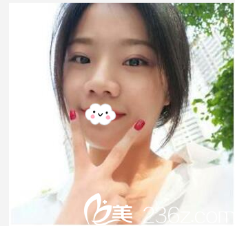 转眼去珠海科美做双眼皮12天了 转眼去珠海科美做双眼皮12天了