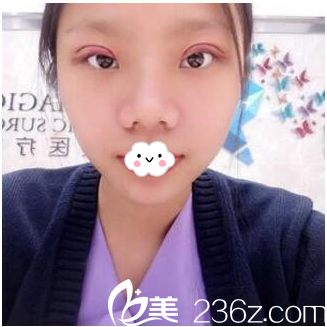 珠海科美张民望院长双眼皮做完第二天 珠海科美张民望院长双眼皮做完第二天