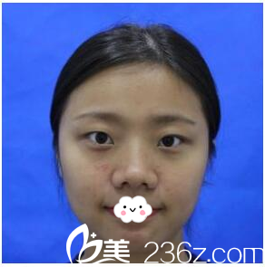 术前单眼皮照片 术前单眼皮照片