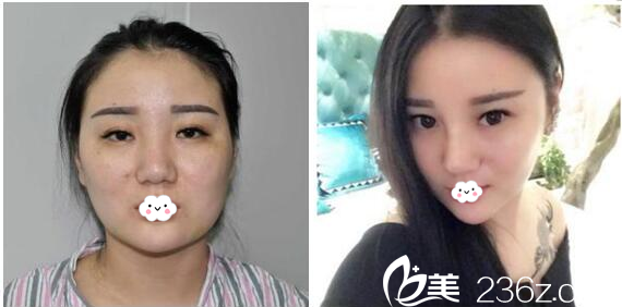 汕头爱丽诺整形医院苏国艺做的面部溶脂+隆鼻案例