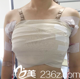 术后第二天 术后第二天