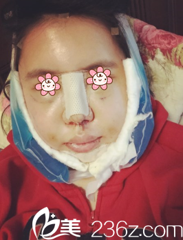 <!--<i data=20240703-sp></i>-->面部吸脂术后3天