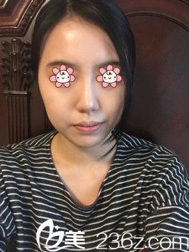 <!--<i data=20240703-sp></i>-->张凯鼻综合术后半个月