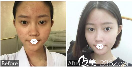 汕头曙光梁威杰做的黄金微针祛痘案例 汕头曙光梁威杰做的黄金微针祛痘案例