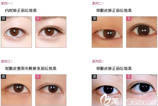 大小眼怎么办？南宁慧美双眼皮手术9800元起帮你塑造美眼