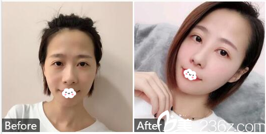 汕头曙光医生高定新鼻综合隆鼻案例