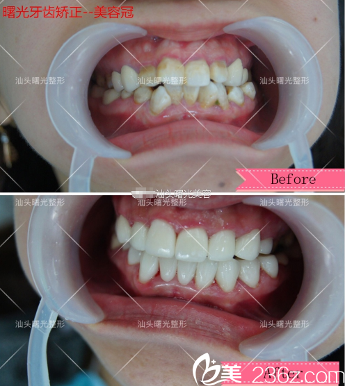 汕头曙光庞观养做的美容冠牙齿矫正案例 汕头曙光庞观养做的美容冠牙齿矫正案例