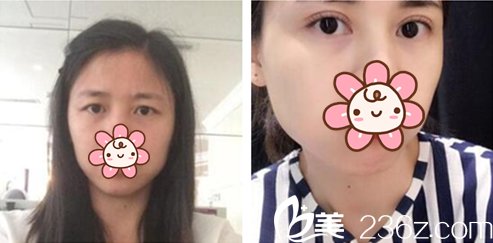 朴秀万院长眼部整形案例 朴秀万院长眼部整形案例