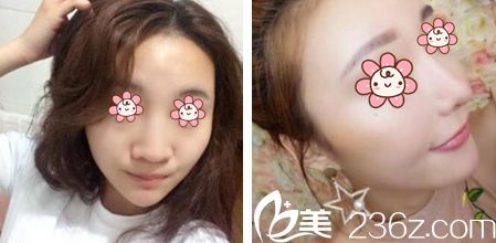 徐仁洙院长鼻整形案例