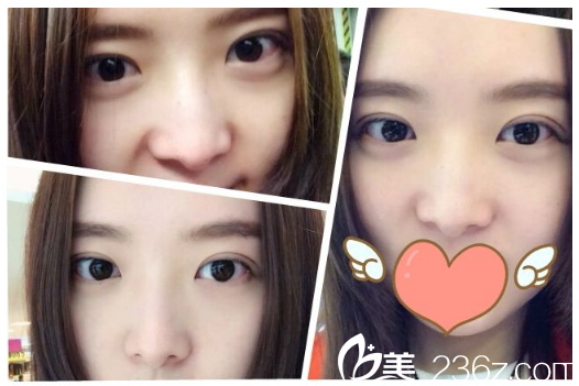 深圳北大医院李天石医生双眼皮