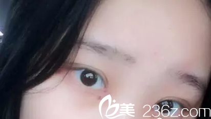 深圳北大医院双眼皮哪个医生好？崔永言、李天石、胡新华割双眼皮技术都很厉害