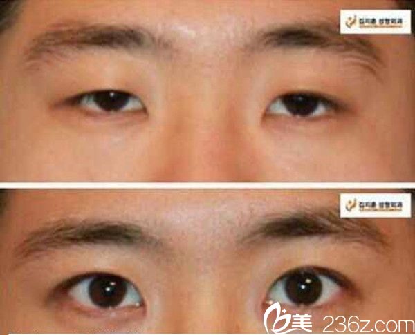 金志薰院长双眼皮手术案例 金志薰院长双眼皮手术案例