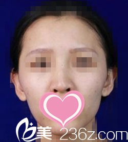 术前照片 术前照片