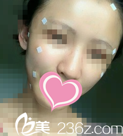 脂肪填充全脸天 脂肪填充全脸天