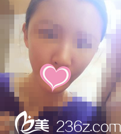 术后第3天效果 术后第3天效果