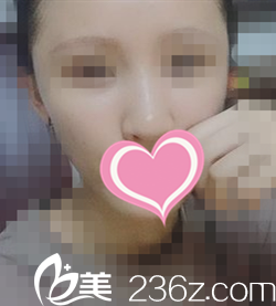 术后一周恢复情况 术后一周恢复情况