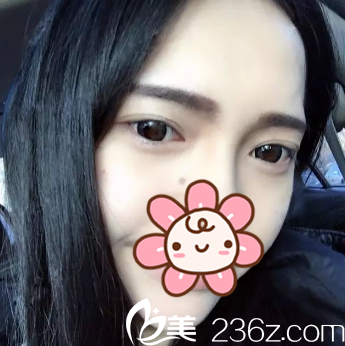 <!--<i data=20240703-sp></i>-->院长给我去完眼袋半个月了