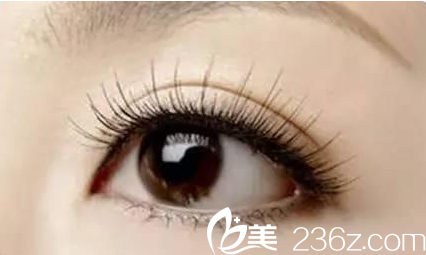 双眼皮整形手术