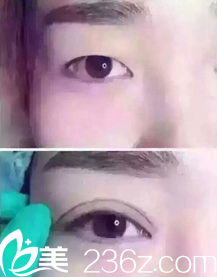 双眼皮整形前后效果对比