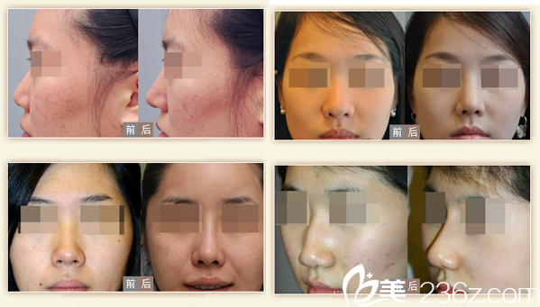 <!--<i data=20240703-sp></i>-->整形医院自体耳软骨隆鼻