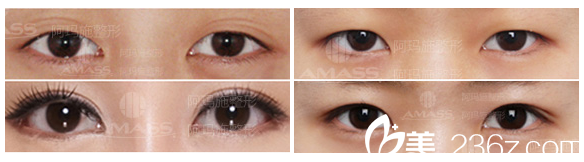 <!--<i data=20240703-sp></i>-->整形医院双眼皮