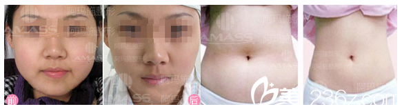 广州爱来（阿玛施）整形医院面部抽脂和腰腹部抽脂案例