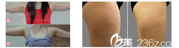 <!--<i data=20240703-sp></i>-->整形医院手臂和大腿吸脂