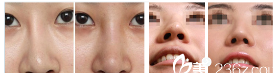 <!--<i data=20240703-sp></i>-->整形医院隆鼻失败修复