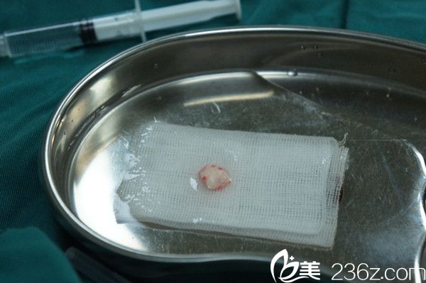 取耳软骨垫鼻尖 取耳软骨垫鼻尖