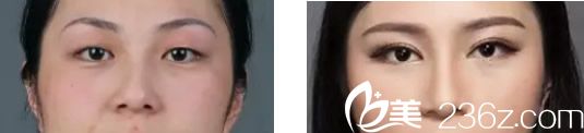 双眼皮+隆鼻前后效果对比图