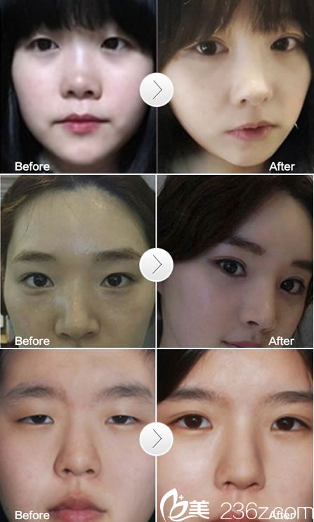 宁波尚丽整形双眼皮案例 宁波尚丽整形双眼皮案例