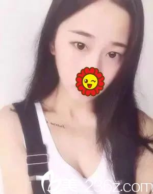 做双眼皮手术前的内双照片 做双眼皮手术前的内双照片