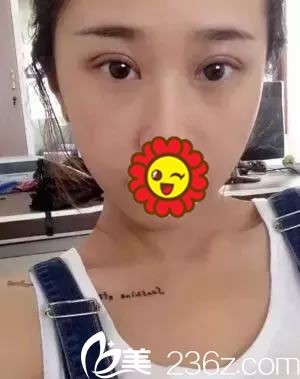 做双眼皮手术第7天拆线的<span style= 做双眼皮手术第7天拆线的<span style=