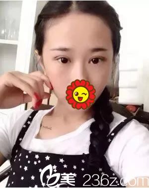 找徐建国割双眼皮手术10天<span style= 找徐建国割双眼皮手术10天<span style=