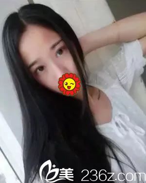 宁波建国整形做双眼皮15天恢复照 宁波建国整形做双眼皮15天恢复照