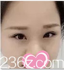 你看我在北京医院整形外科找赵红艺做的双眼皮修复效果如何