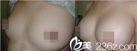 韩国Lilac BLC整形外科医院案例