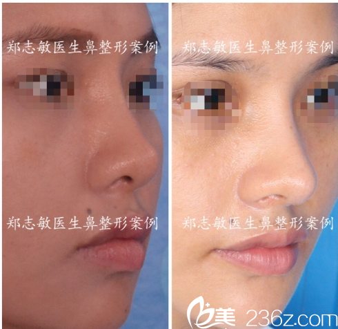东莞美立方郑志敏做的中隔软骨鼻综合隆鼻案例 东莞美立方郑志敏做的中隔软骨鼻综合隆鼻案例