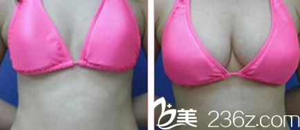 延吉李京云整形假体隆胸案例对比图