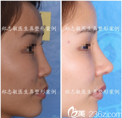东莞美立方郑志敏医生肋软骨鼻综合隆鼻案例图 东莞美立方郑志敏医生肋软骨鼻综合隆鼻案例图