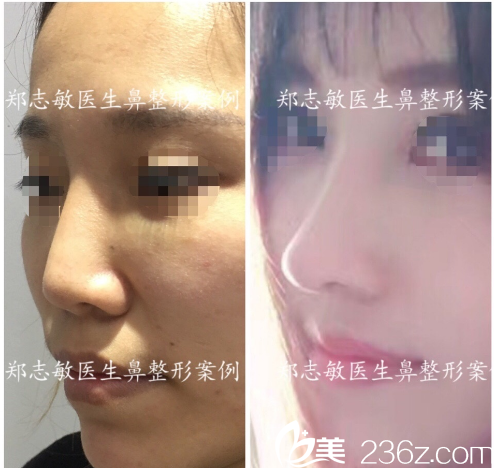 东莞美立方郑志敏全肋鼻综合修复案例图 东莞美立方郑志敏全肋鼻综合修复案例图