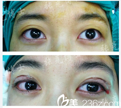 东莞美立方张克医生双眼皮修复案例 东莞美立方张克医生双眼皮修复案例