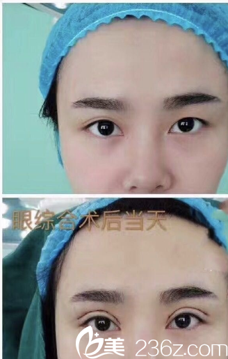 东莞美立方张克医生做的双眼皮眼综合案例 东莞美立方张克医生做的双眼皮眼综合案例