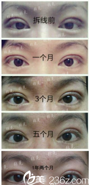 东莞美立方张克医生双眼皮案例恢复过程图 东莞美立方张克医生双眼皮案例恢复过程图