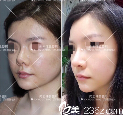 东莞美立方向宏伟医生肋软骨鼻修复案例 东莞美立方向宏伟医生肋软骨鼻修复案例