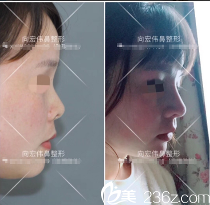 东莞美立方向宏伟医生肋软骨鼻综合隆鼻案例 东莞美立方向宏伟医生肋软骨鼻综合隆鼻案例