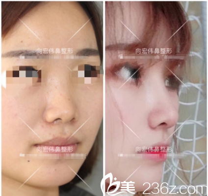 东莞美立方向宏伟医生肋软骨隆鼻案例效果图片 东莞美立方向宏伟医生肋软骨隆鼻案例效果图片