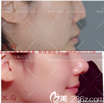 东莞美立方向宏伟医生肋软骨隆鼻案例 东莞美立方向宏伟医生肋软骨隆鼻案例